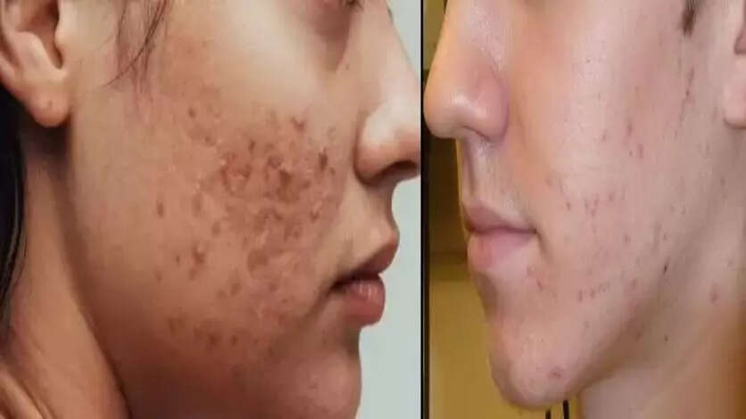 Home Remedies For Pimples In Summerpimples