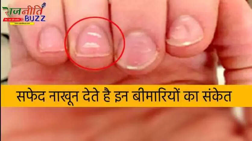 White Spot On Nail